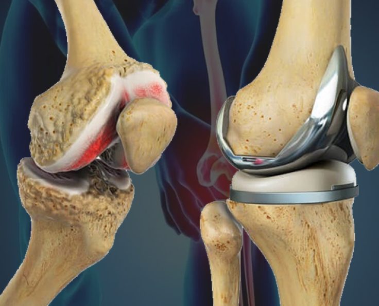 totalkneereplacement